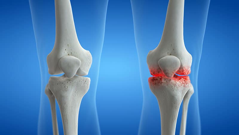 What is Arthritis?