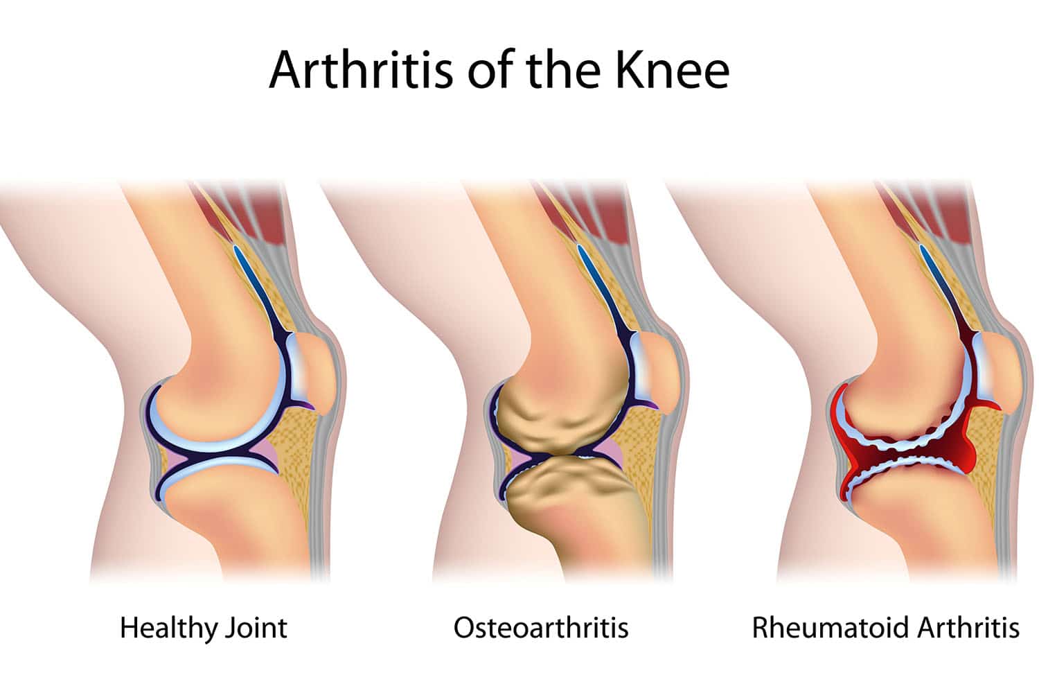 Is Arthritis Hereditary? Understanding factors of Arthritis