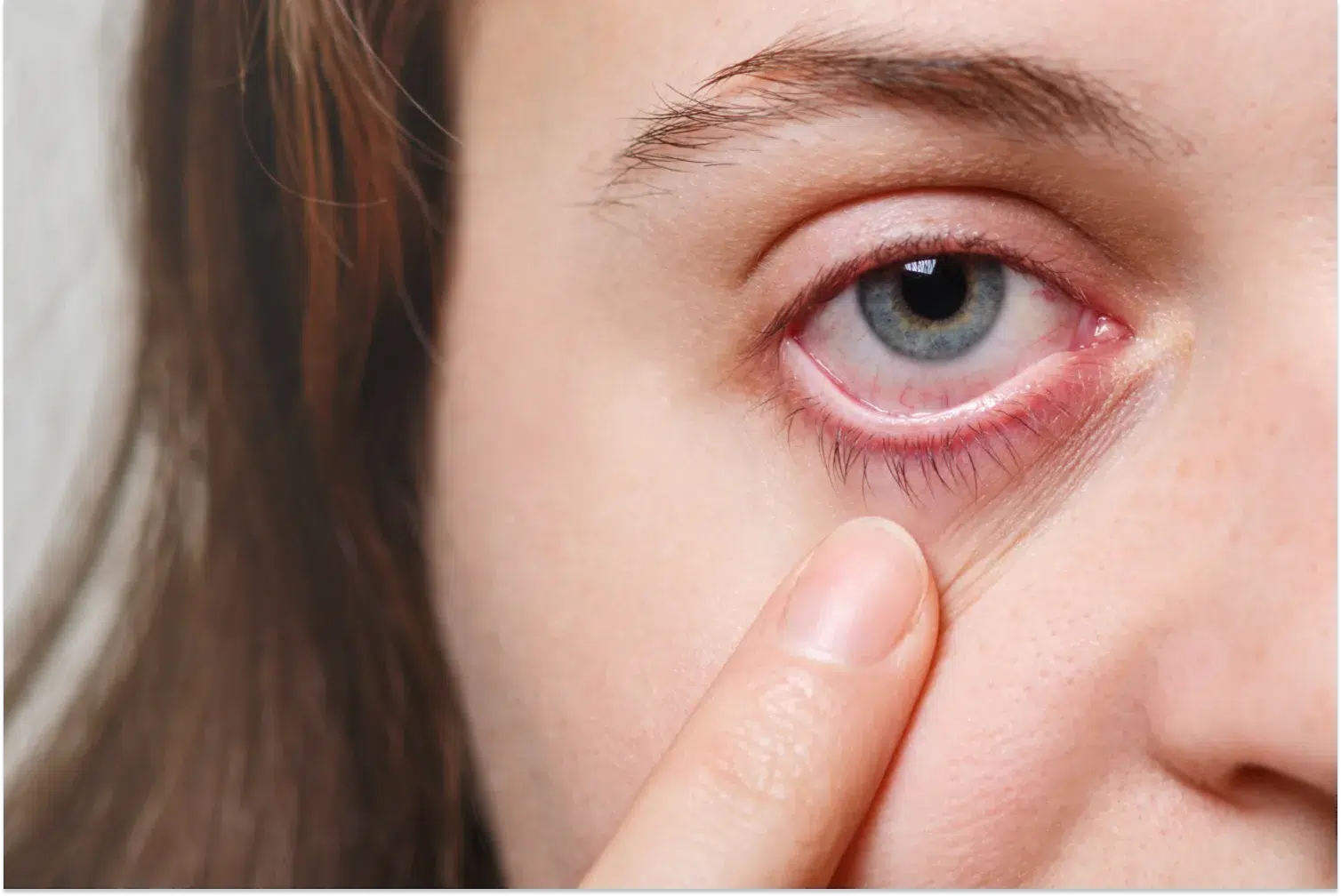 Does CBD Make Your Eyes Red?